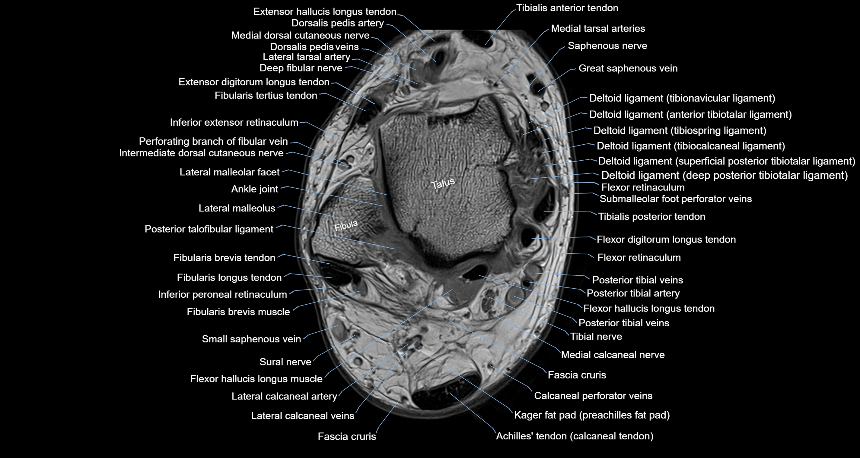 Ankle axial anatomy 3T MRI images -img-10001-00017.webp